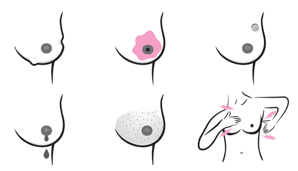 乳癌症狀有哪些？這些變化該留意