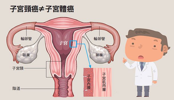 康健知識庫│什麼是子宮頸癌？