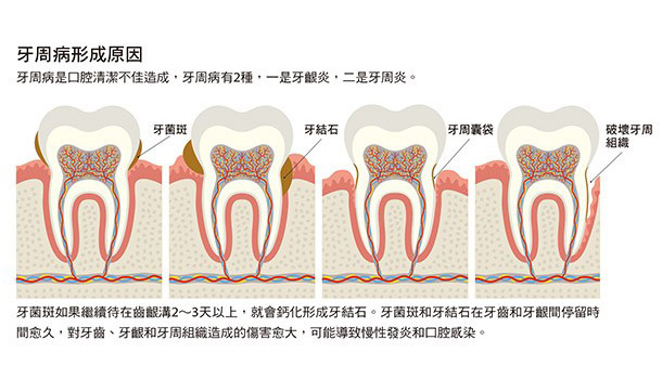 沒蛀牙≠健康！牙周病害你全口崩盤